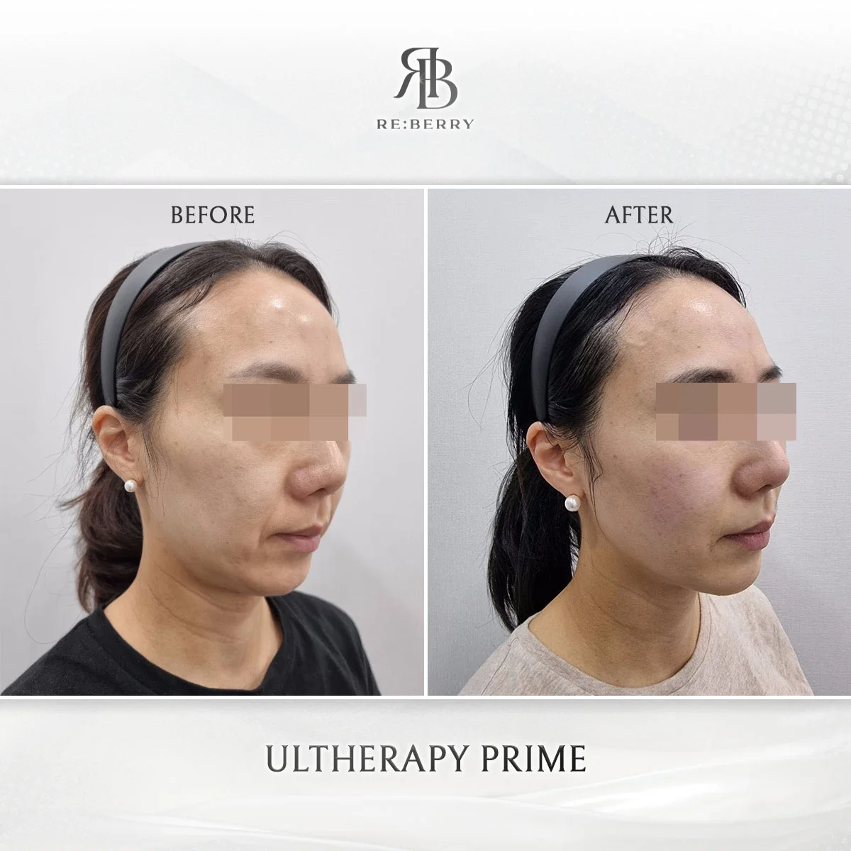 Ultherapy Prime HIFU before and after — female patient facial contouring and skin tightening result at RE:BERRY Clinic
